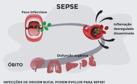 Sepse 240625